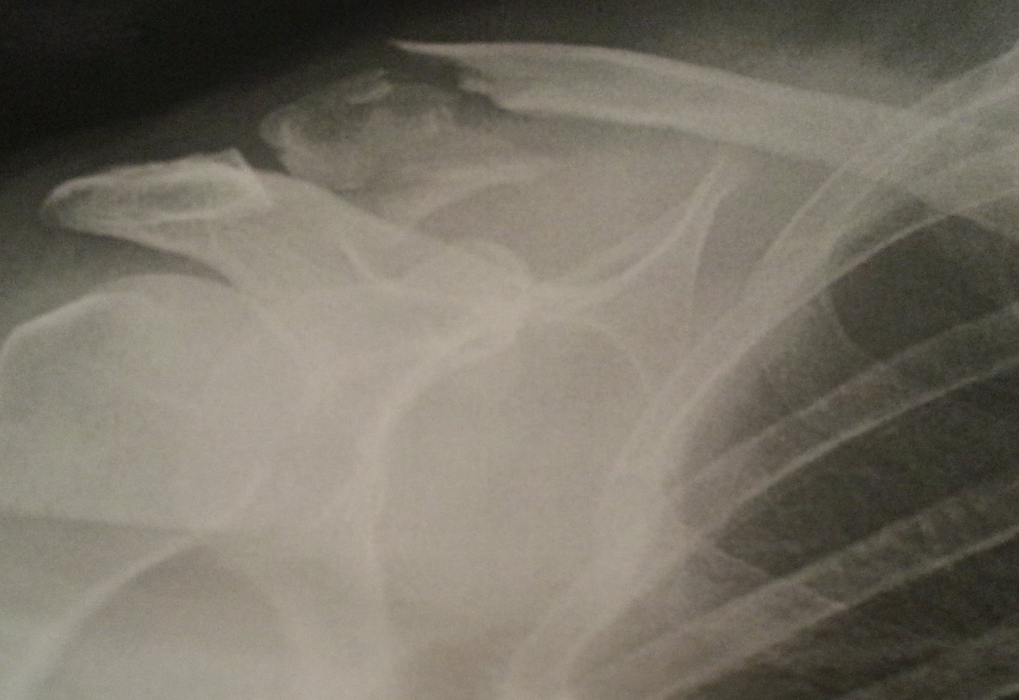 Broken-collarbone