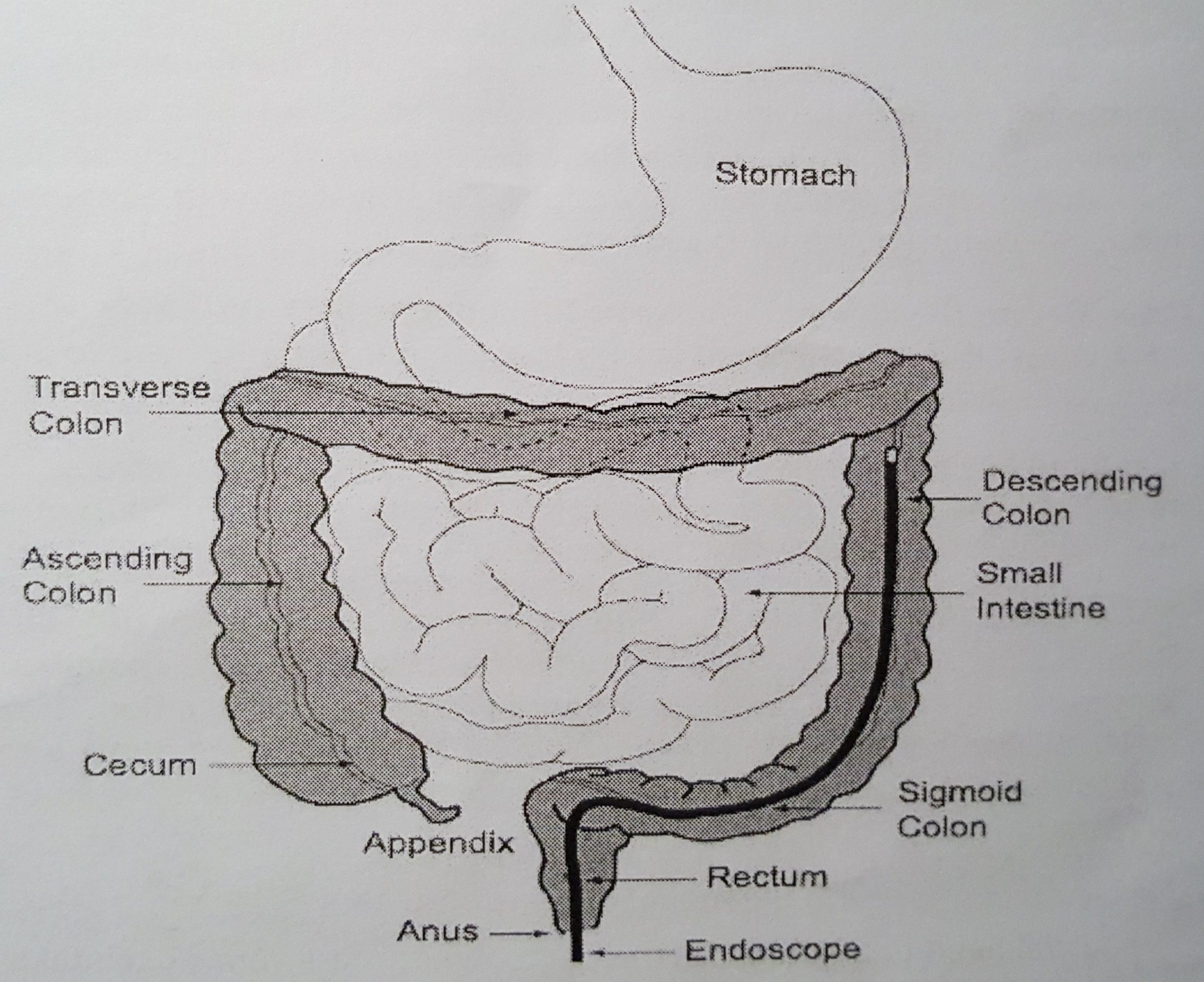 Colonoscopy Diagram 