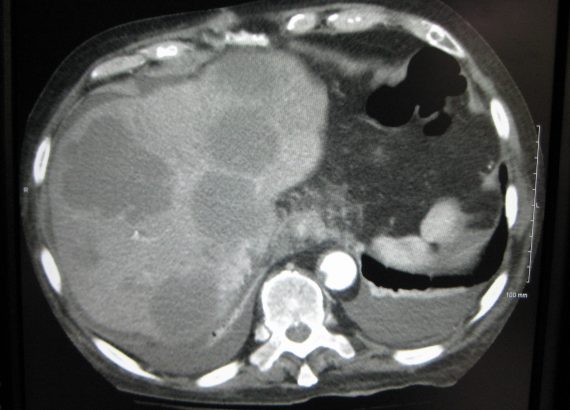 Liver mets on a CT Scan.