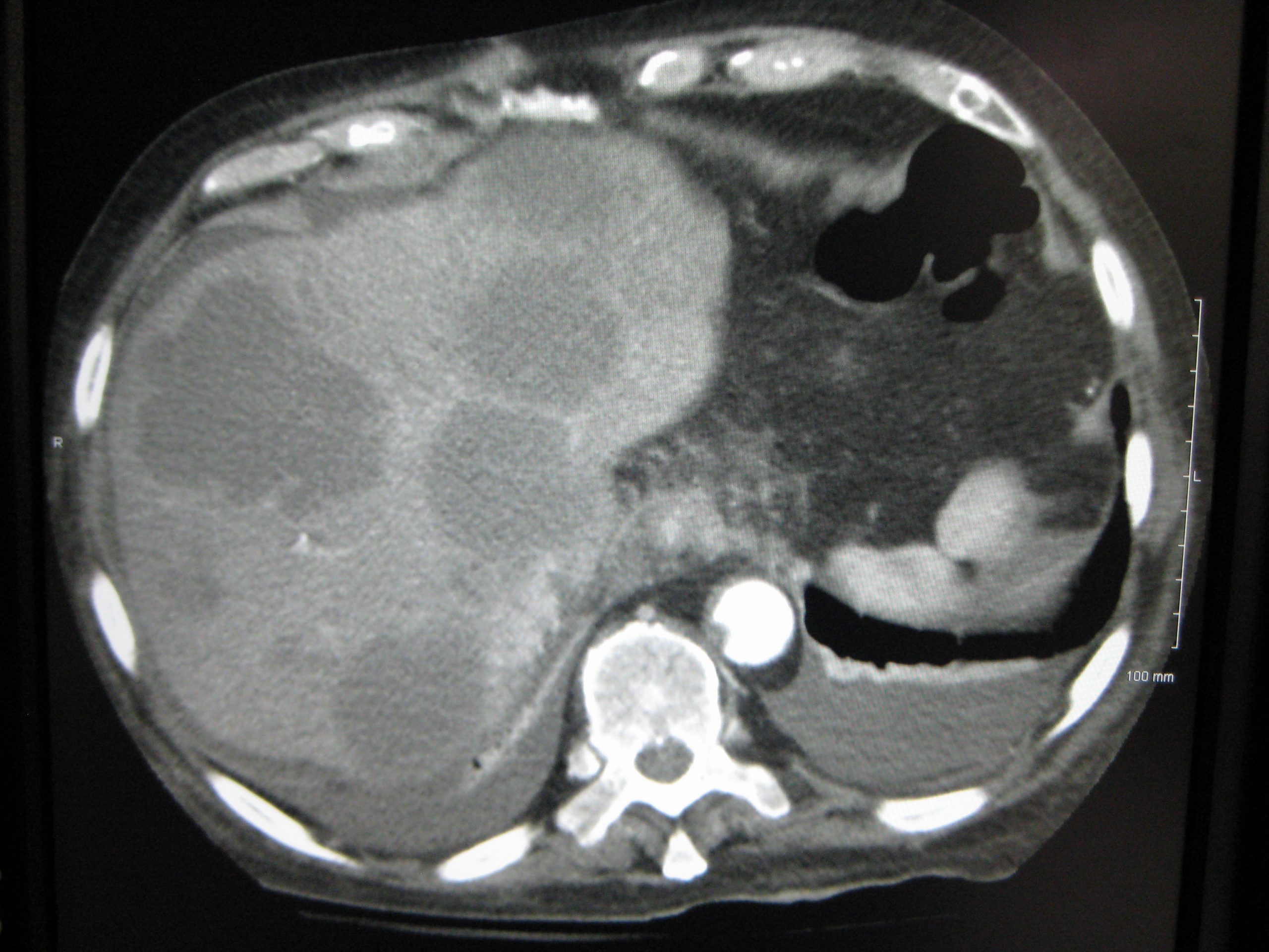 Liver mets on a CT Scan.