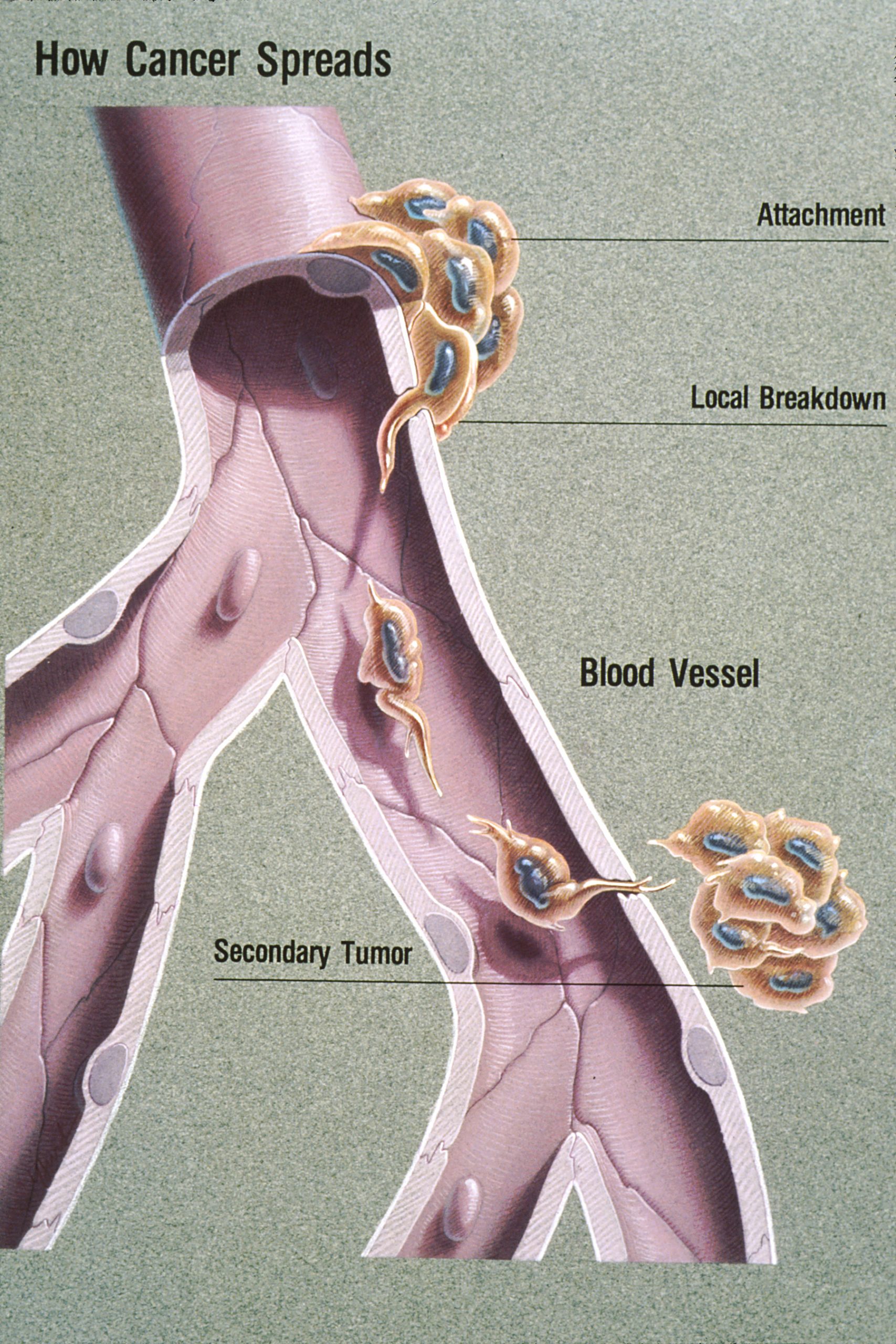 How-cancer-Spreads