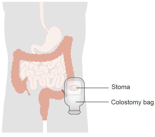 Colostomy-Bag