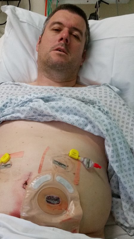 Waking With A Colostomy Bag After Bowel Surgery Tales From Paul Lewis