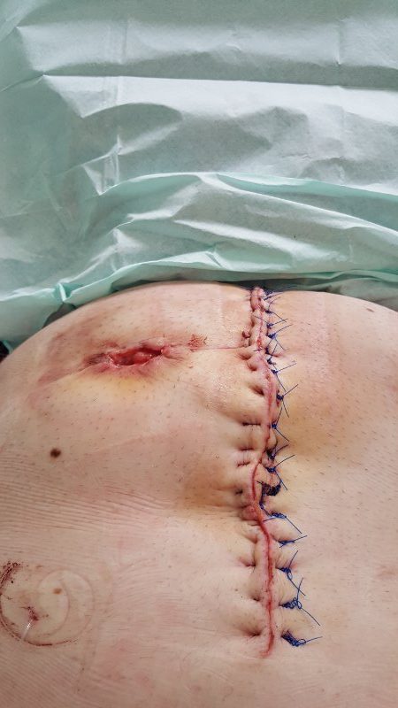 colostomy scar