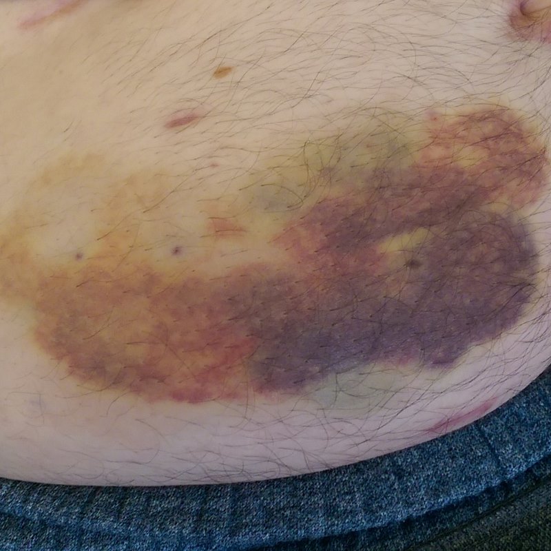 Clexane bruising